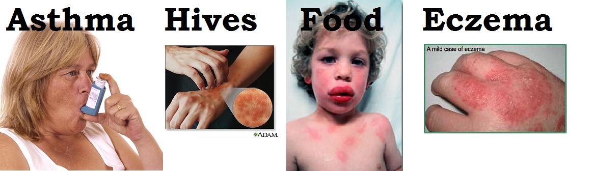 hay fever is an example of what type of hypersensitivity
